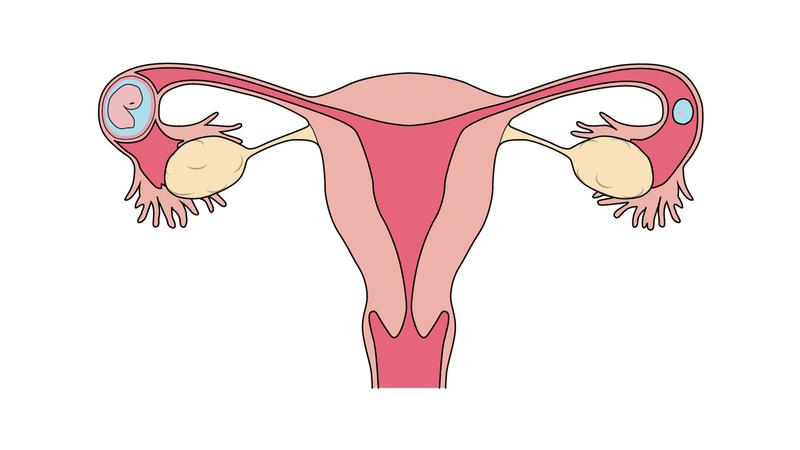 ectopic-pregnanc